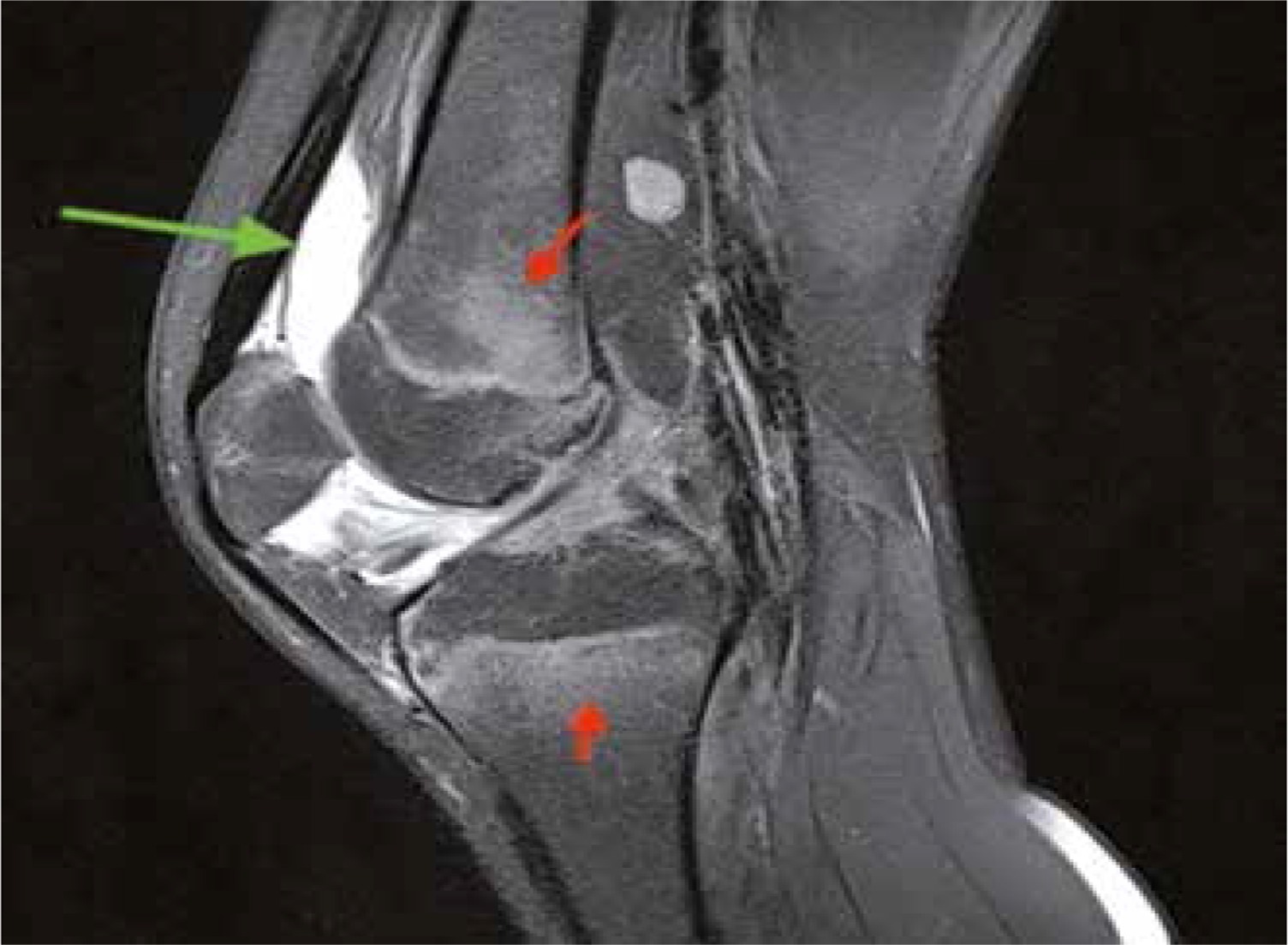 Magnetic Resonance Imaging Of The Knee Joint In Juvenile Idiopathic