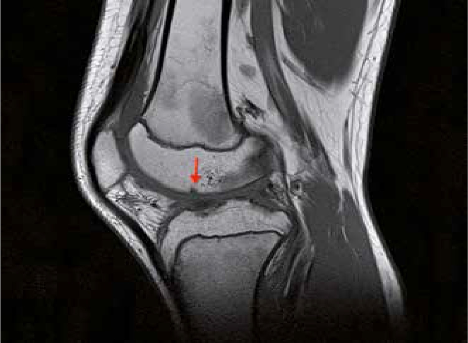 Magnetic Resonance Imaging Of The Knee Joint In Juvenile Idiopathic ...