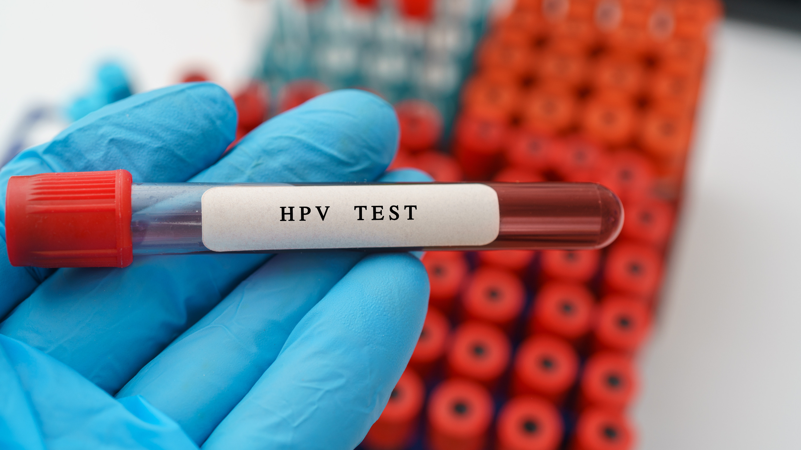 test-na-hpv-jako-podstawowa-metoda-w-profilaktyce-raka-szyjki-macicy